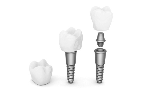 How To Extend The Life Of Your Implant Crown